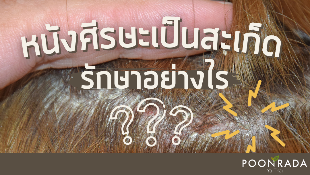 หนังศีรษะเป็นสะเก็ด รักษาอย่างไร