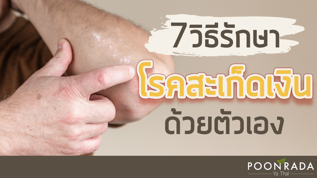 7วิธีรักษาสะเก็ดเงินด้วยตัวเอง