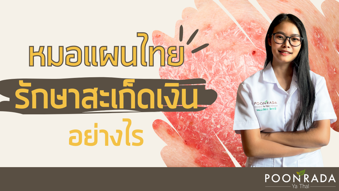 หมอแผนไทยรักษาสะเก็ดเงินอย่างไร?