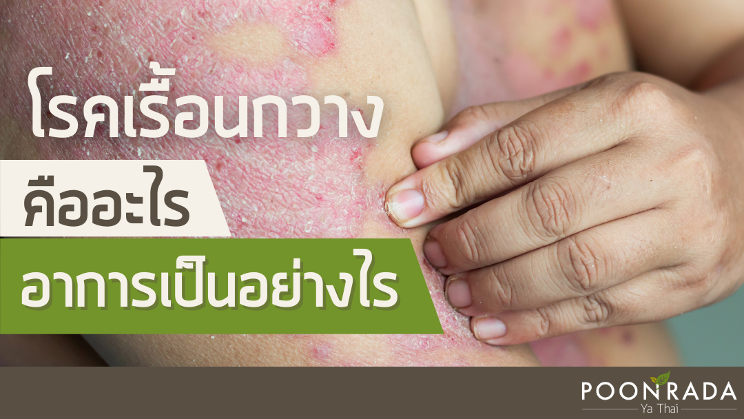 โรคเรื้อนกวาง คืออะไร อาการเป็นอย่างไร?