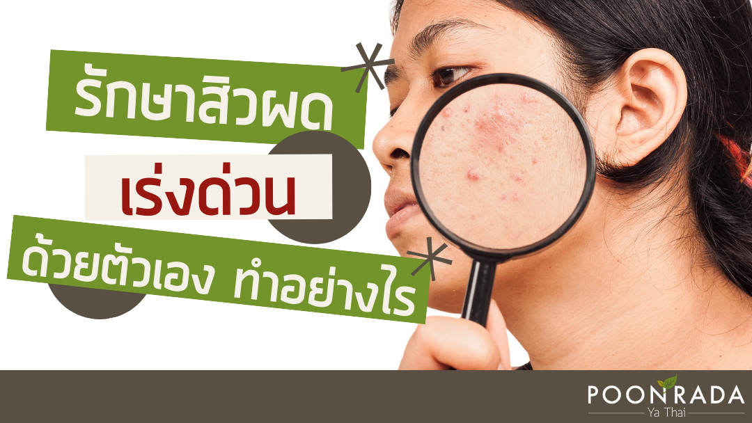 รักษาสิวผด เร่งด่วน! ด้วยตัวเองทำอย่างไร?