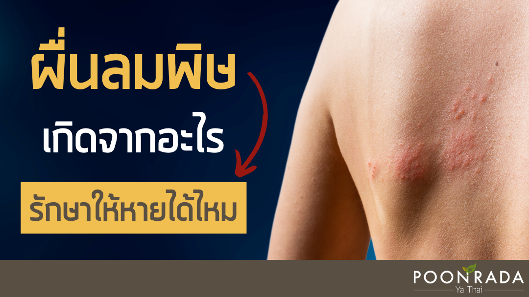 ผื่นลมพิษเกิดจากอะไร สามารถรักษาให้หายได้ไหม