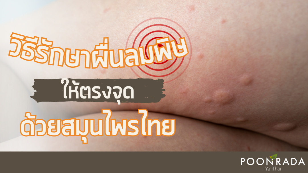 วิธีรักษาผื่นลมพิษให้ตรงจุดด้วยสมุนไพรไทย